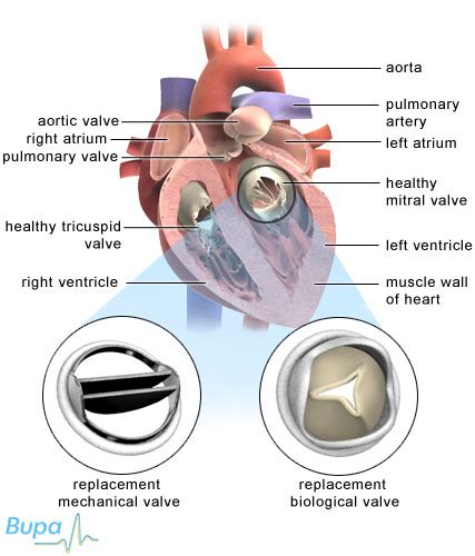 Valve Replacement Surgery: Bicuspid Aortic Valve Replacement Surgery ...