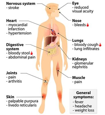 Herbal Remedies for Wegener’s Granulomatosis, Ayurvedic Treatment