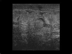 Breast and Axilla | 5.1 Benign lesions : Case 5.1.11 Inflammation | Ultrasound Cases