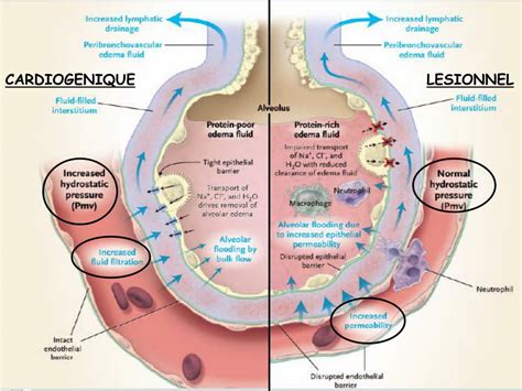 Pulmonary Edema