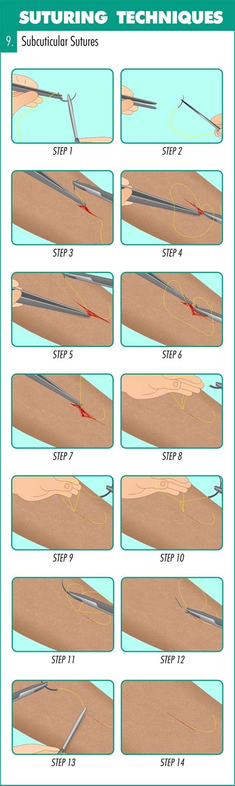 Complete Guide to Mastering Suturing Techniques | Suture techniques, Sutures, Nursing mnemonics