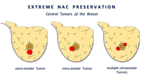 Extreme NAC Preservation - YouTube