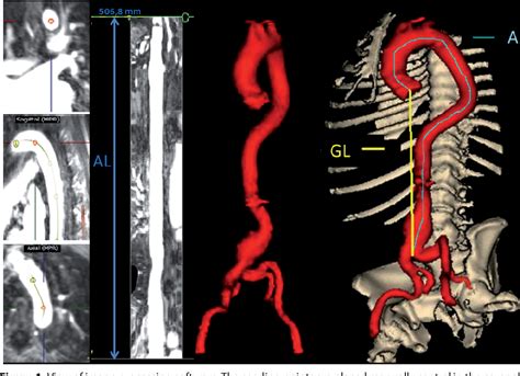 Figure 1 from Increased aortic tortuosity indicates a more severe ...