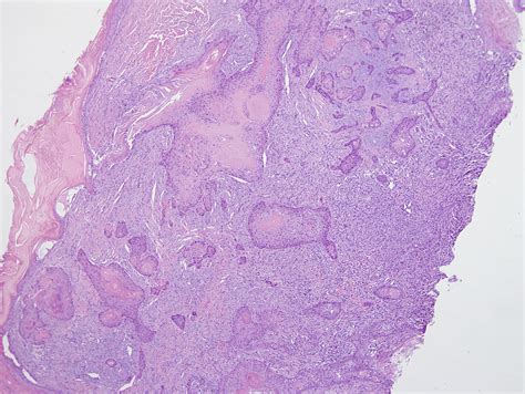 Collision Tumor Comprised of Atypical Fibroxanthoma and Invasive ...