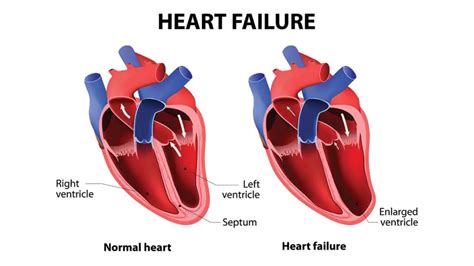 Systolic Heart Failure: Symptoms, Causes, Diagnosis, Treatment ...