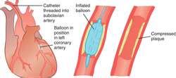 Percutaneous transluminal coronary angioplasty | definition of percutaneous transluminal ...