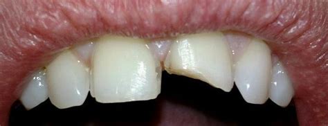 Broken Front Tooth Before & After Photos | Schertz TX