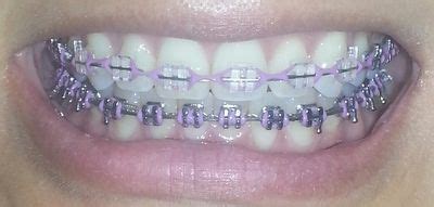 braces colors - lavender | BRACES | Pinterest | Colors, The o'jays and This summer