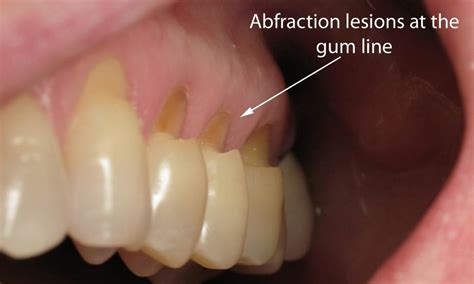 What are Abfractions? – Smileinsight Dental – San Diego CA