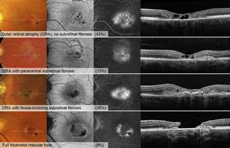 Macular Telangiectasia Type 2: Visual Acuity, Disease End Stage, and the MacTel Area - Ophthalmology