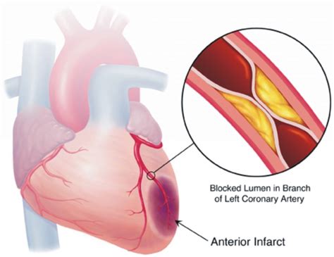 Myocardial Ischemia Causes, Symptoms, Diagnosis and Treatment - Natural Health News