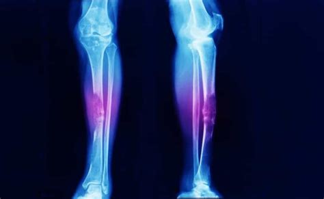 Everything You Need to Know About Bone Cancer: Overview, Causes, Types, Signs and Symptoms ...