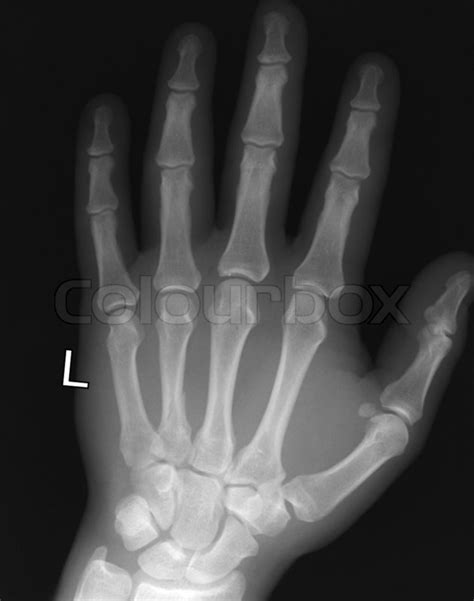 X-ray of human hand | Stock image | Colourbox