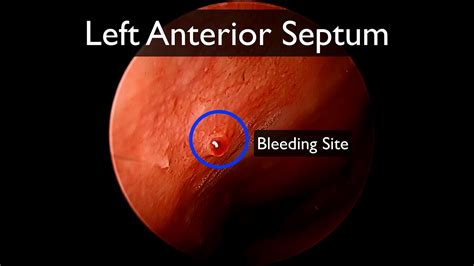 Left nasal cautery with silver nitrate - YouTube