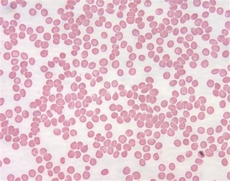 Hematology of Leukemia