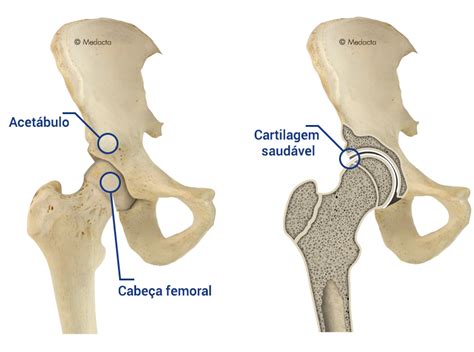 Artrose no quadril | Cirurgia no quadril | Prótese de quadril