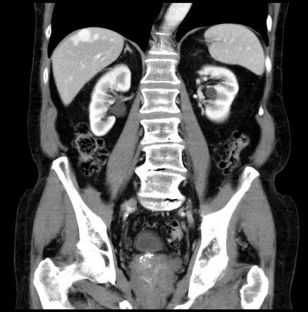 Intrahepatic portosystemic venous shunt | Radiology Case | Radiopaedia.org