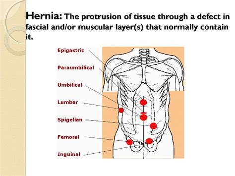 Abdominal Wall Hernias - online presentation