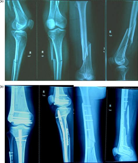 Floating knee: A modified Fraser's classification and the results of a series of 28 cases - Injury