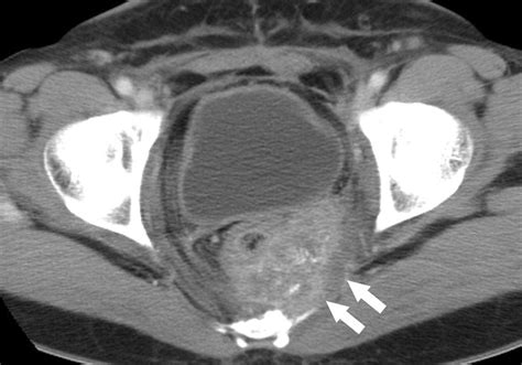 Uterus Cervix Removal After