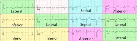 Memorizing ECG leads to heart anatomy : r/medicalschool