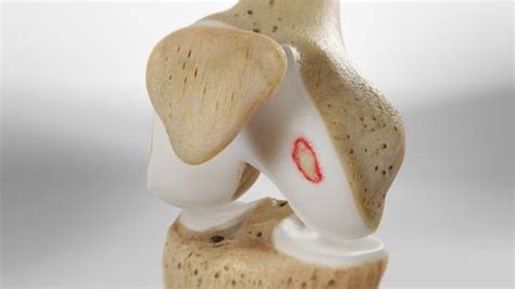 Arthroscopic Knee Chondroplasty