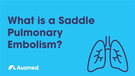 What is a Saddle Pulmonary Embolism (PE)? | Ausmed