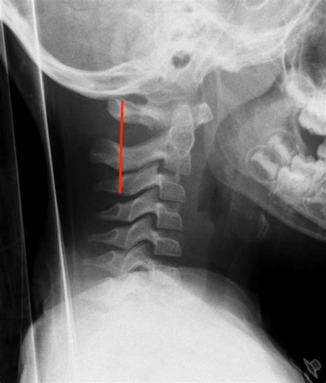 C-spine x-ray interpretation - Don't Forget the Bubbles