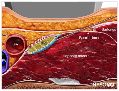 Ultrasound-Guided Femoral Nerve Block - NYSORA