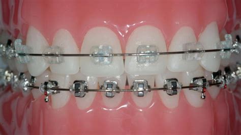 Ceramic Braces: Ancient Origins, Bright Future? Benefits & Drawbacks