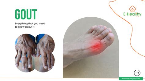 Gout: Symptoms, Diagnosis, Causes, and Treatment - E Healthy Info