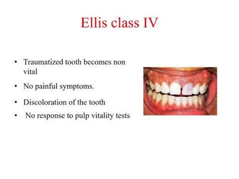 ELLIS CLASSIFICATION OF FRACTURE - YouTube