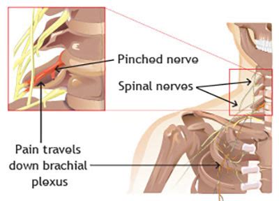 Home Treatment For Pinched Nerve In Neck And Shoulder - My Bios