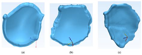 Bioengineering | Free Full-Text | Bespoke Implants for Cranial Reconstructions: Preoperative to ...