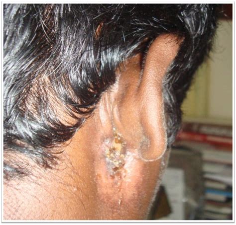 Osteoma Mastoid with Cholesteatoma of External Auditory Canal - A Rare Presentation