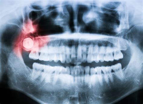 We finally know why wisdom teeth emerge so late | Popular Science