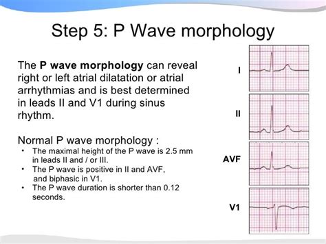 ECGpedia - ECG Presentation