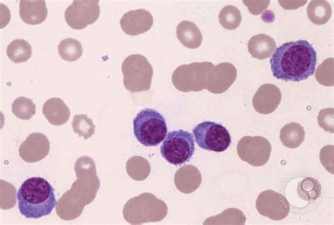 Plasma Cell Leukemia - 2.