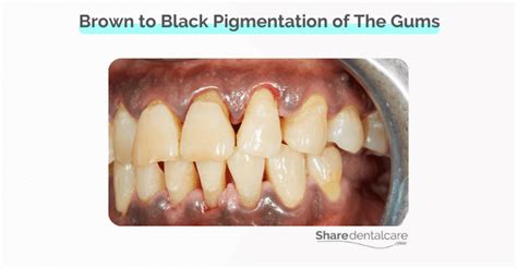 Black Gums from Smoking Treatment Options - Share Dental Care