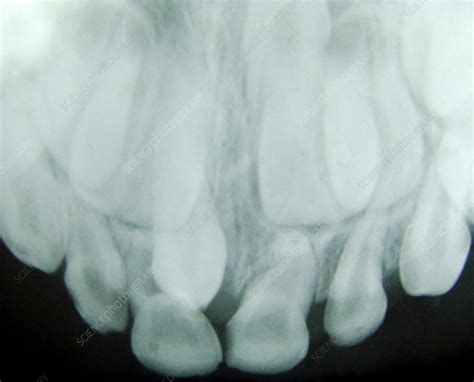 Supernumerary Teeth, X-Ray - Stock Image - C042/9935 - Science Photo ...