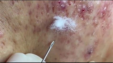 Acne Removal Treatment Super Satisfying Blackhead Removal #5 - YouTube