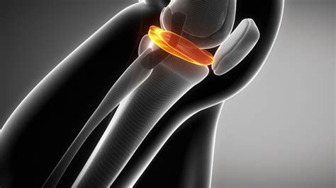 Types of meniscal injuries: Lateral meniscus injury