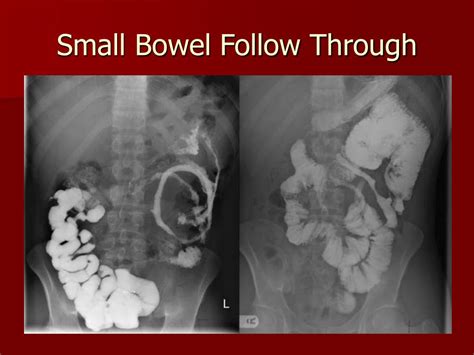 PPT - Radiographic Imaging in Inflammatory Bowel Disease PowerPoint ...