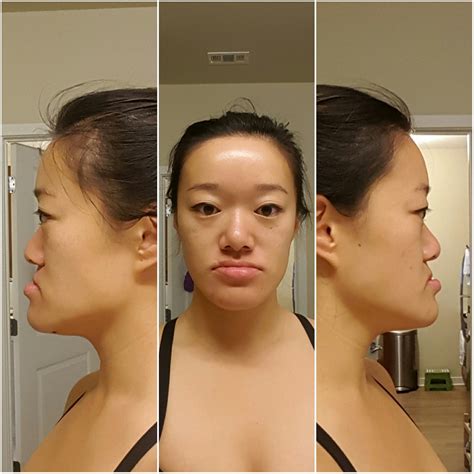 Double Jaw Surgery Before During And After Pictures V - vrogue.co