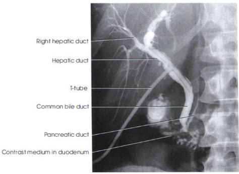 Postoperative Cholangiography - RadTechOnDuty