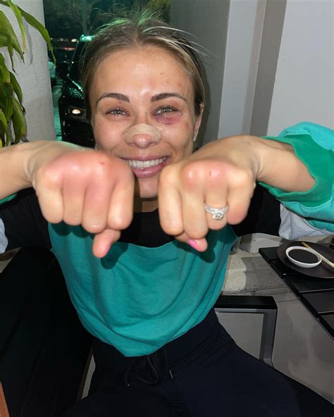 Paige VanZant's Bare Knuckles After Bare Knuckle Fighting : r/WMMA