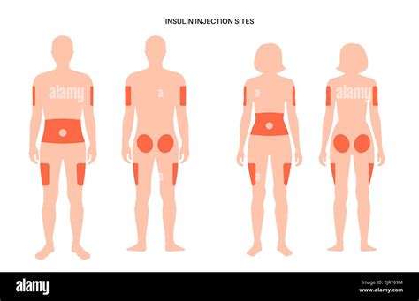 Insulin injection sites, illustration Stock Photo - Alamy