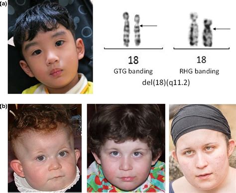 Clinical delineation of 18q11‐q12 microdeletion: Intellectual ...