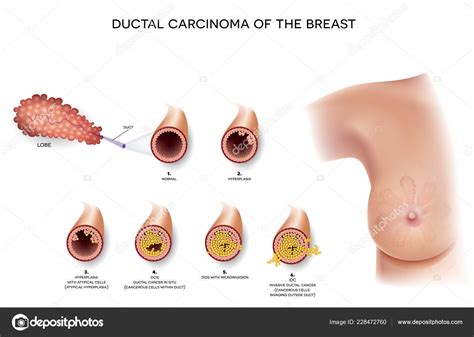 Ductal Carcinoma Breast Detailed Medical Illustration Beginning Normal ...