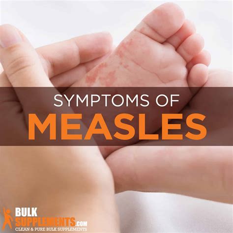 Measles: Symptoms, Causes & Treatment